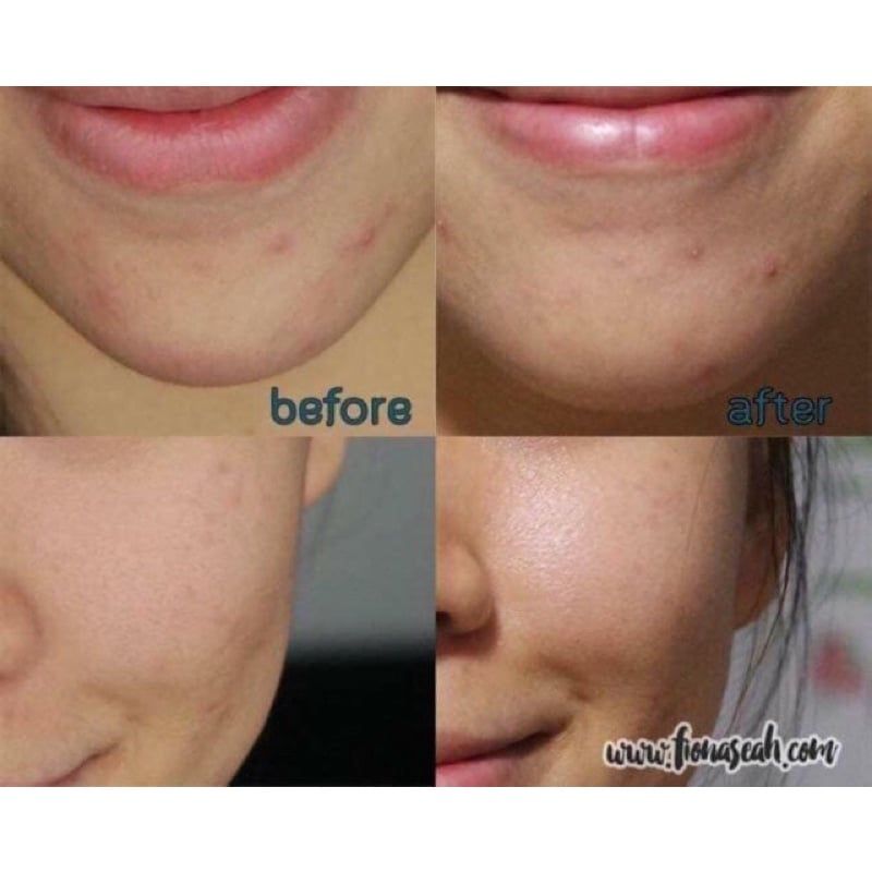 Gel chấm mụn Origins Spot Remover