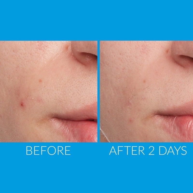 Gel chấm mụn Origins Spot Remover