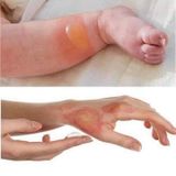 A326- Thuốc trị phỏng, vết thương Neosporin 28.3g