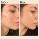 A323 - Serum giảm mụn Kyung Lab Acnes Centella Asiatica Ampoule 50ml