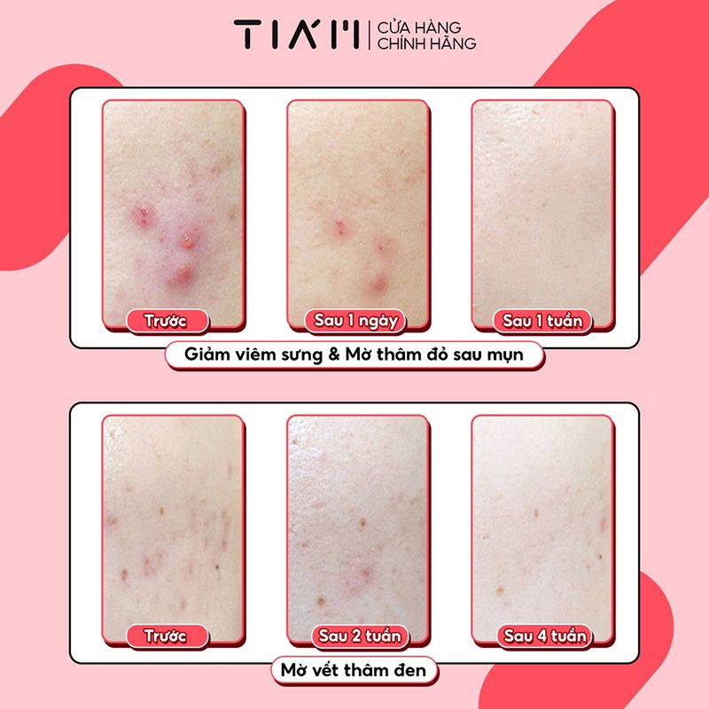 Kem Chấm Mụn Tiam Hỗ Trợ Giảm Viêm Sưng, Ngăn Ngừa Vết Thâm Sẹo AC Fighting Spot RX Cream 30g