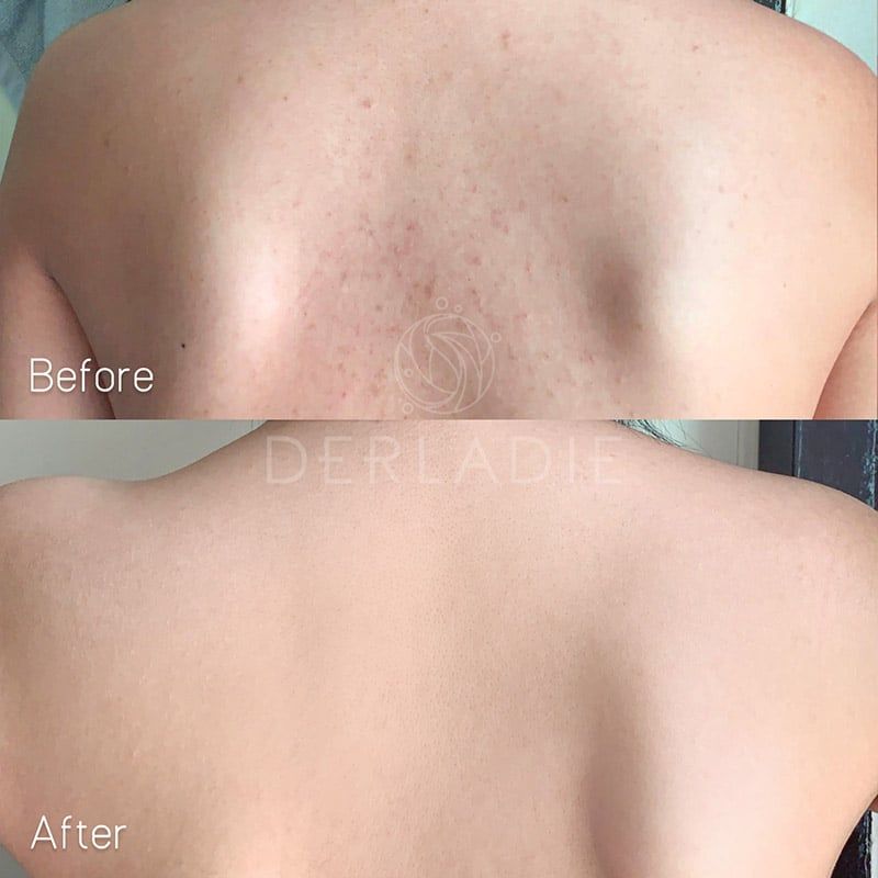 Xà Phòng Derladie Hỗ Trợ Giảm Mụn Cơ Thể Body Cleansing Bar For Blemish Skin 50g