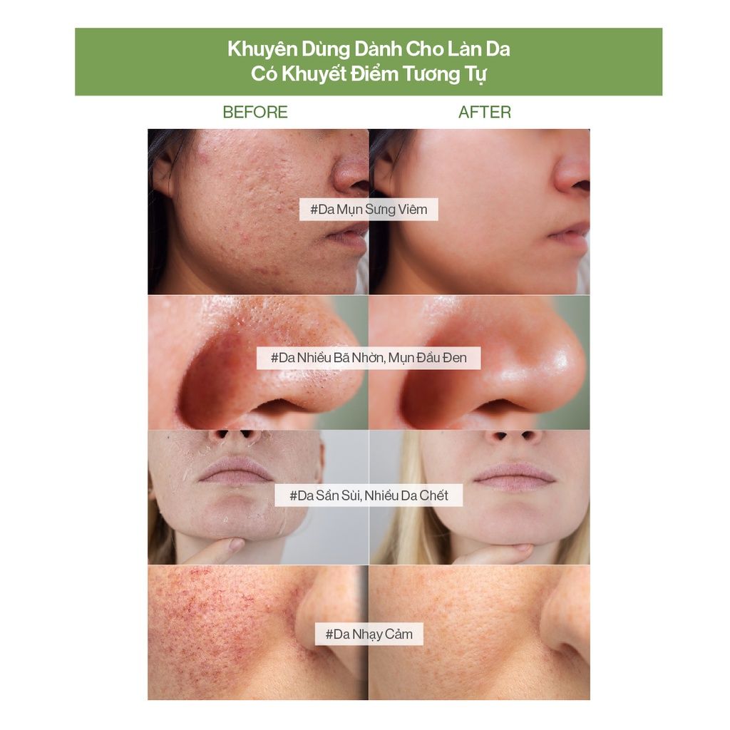 Sữa Rửa Mặt Gilaa Làm Sạch Da Hỗ Trợ Giảm Mụn Chiết Xuất Khổ Qua Và BHA Plant Serum Cleanser Bitter Melon + BHA 160g