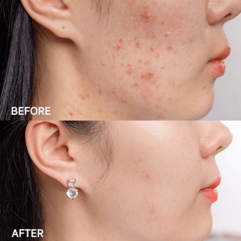 Gel Derma Forte Topical Gel 15g Hỗ Trợ Giảm Mụn, Giảm Thâm 15g