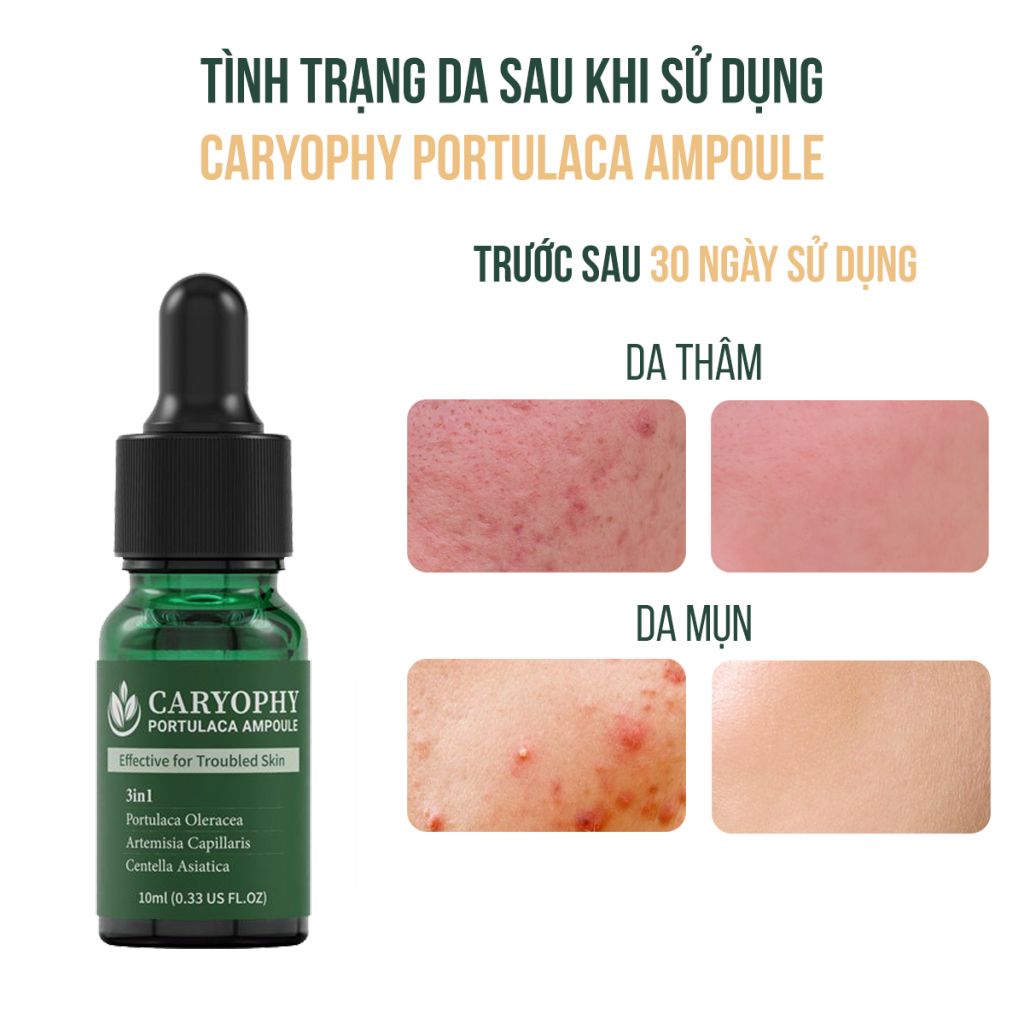 Tinh Chất Caryophy Chăm Sóc Cho Da Mụn Portulaca Ampoule 30ml