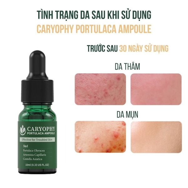  Tinh Chất Caryophy Chăm Sóc Cho Da Mụn Portulaca Ampoule 30ml 