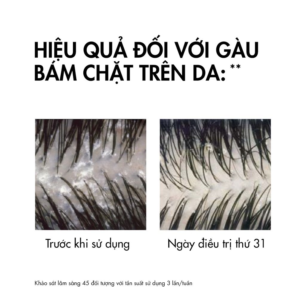 [200ml] Dầu Gội Vichy Làm Sạch Gàu, Hỗ Trợ Giảm Ngứa Dành Cho Da Dầu Dercos Anti Dandruff Dermatological Shampoo