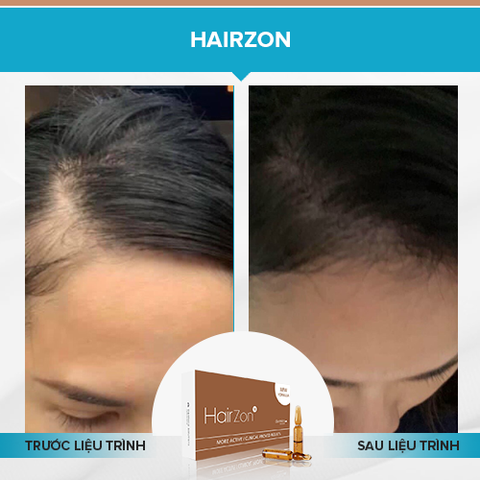 Ampoule hỗ trợ mọc tóc, dài mi, lông mày DERMICA HairZon Thụy Sĩ