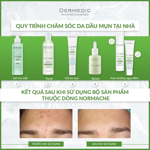 Kem dưỡng chống lão hoá da mụn Dermedic NORMACNE Moisturizing and Regulating Cream