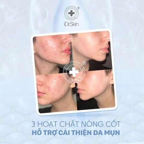 Sữa rửa mặt lên men cho da dầu mụn iDrSkin Facial Cleansing Gel