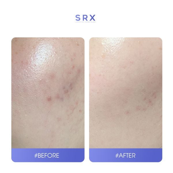 Tái tạo và trẻ hóa da SRX Retinol A Cream