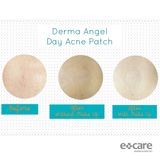  Hộp dán mụn Derma Angel ban đêm 18 miếng 