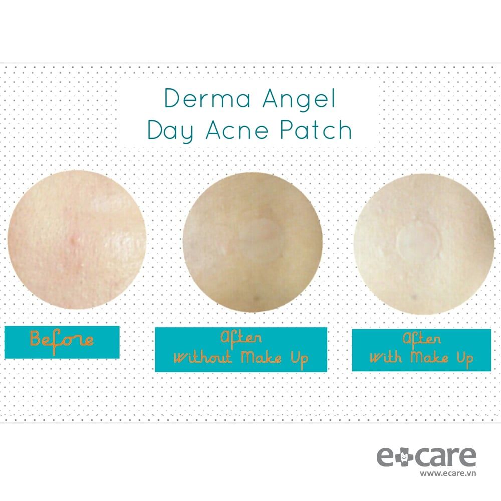  Hộp dán mụn Derma Angel ban đêm 18 miếng 