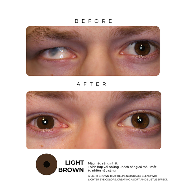  The Aesthetic Contact Lens - The Concealed Contact Lens 