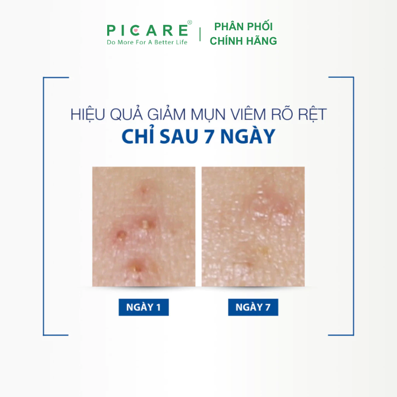 Kem dưỡng Ducray cân bằng dầu giảm viêm mụn Ducray Keracnyl PP Anti-Blemish Soothing Cream 30ml