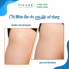 Kem dưỡng giảm rạn da Fixderma Strallium Stretch Mark Cream 75g