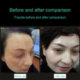  Máy cầm tay Picosecond Portable (Xóa vết xăm lông mày) Máy Laser Plasma Beauty Care Pen, US Plug (Đèn đỏ) 