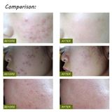  Bút Laser trị mụn K-SKIN KD-7910 Máy xóa nếp nhăn cầm tay Thiết bị xóa sẹo mềm bền Bút trị liệu ánh sáng xanh 