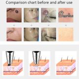  Laser Picosecond Bút xóa tàn nhang Xóa nốt ruồi Vết thâm Lông mày Sắc tố Laser Máy điều trị mụn Công cụ chăm sóc sắc đẹp 