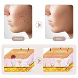  15 bánh răng có thể sạc lại Mole Spotting Pen Laser Beauty Instrument Spot Removal Magic Tool (Màu vàng kim) 