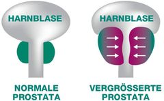 Prostagutt forte 160 / 120mg - Viên uống điều trị tiểu đêm, tiểu buốt ở nam giới (60 viên)