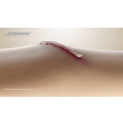 CONTRACTUBEX - Gel trị sẹo lồi, sẹo lõm, sẹo thâm và sẹo biến dạng, tuýp 100g