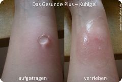MIVOLIS Kühlgel - Gel điều trị vết bỏng và côn trùng cắn, 30 ml