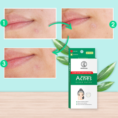 Miếng Dán Mụn Acnes Clear Patch 24 Miếng