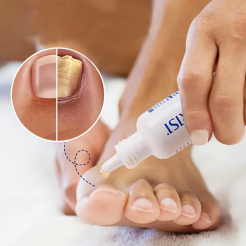 Dung Dịch Trị Nấm Móng Varisi Nail Solution