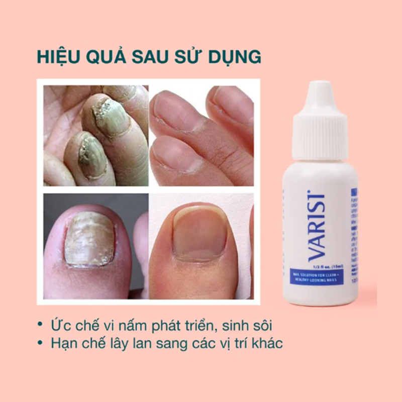 Dung Dịch Trị Nấm Móng Varisi Nail Solution