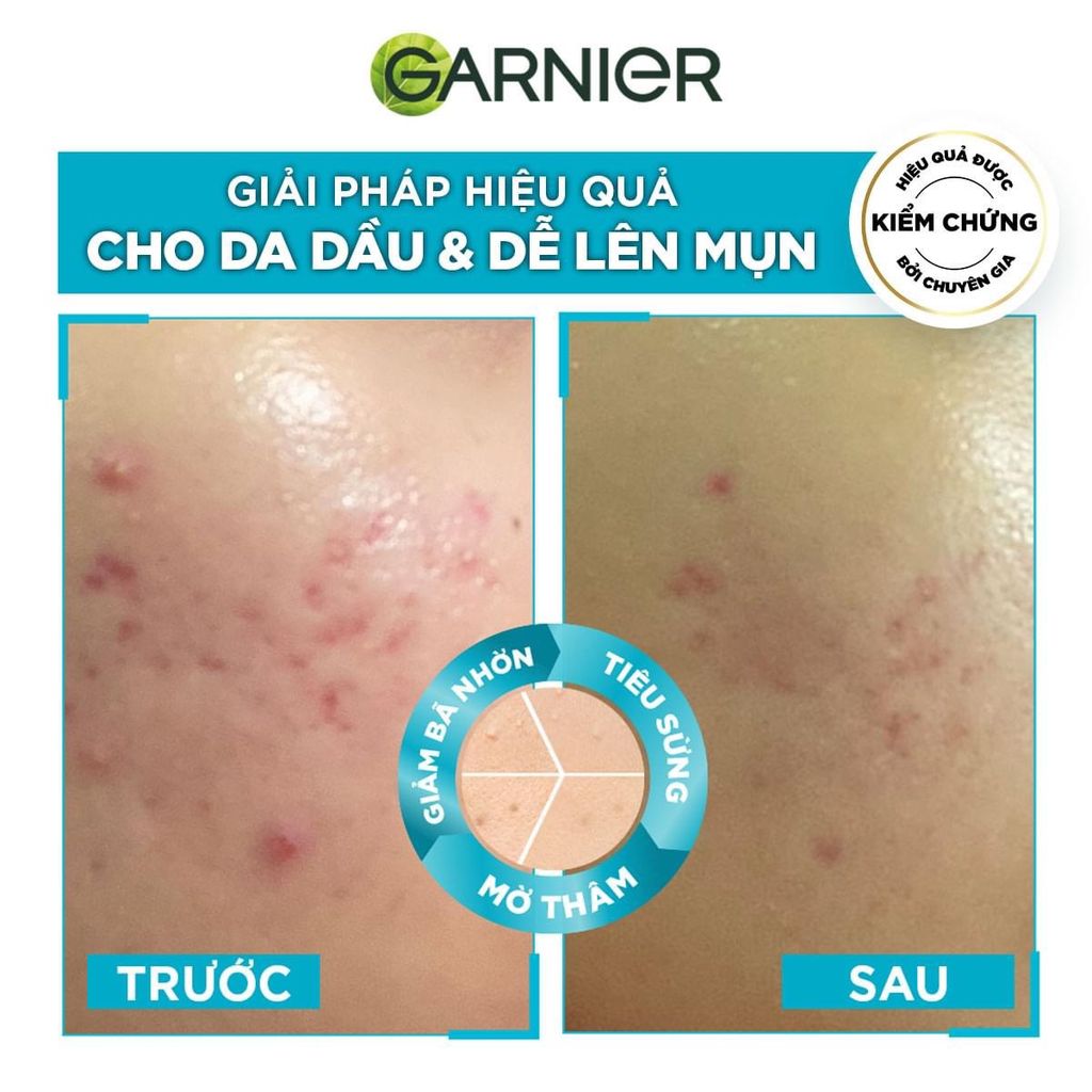 Tinh Chất Garnier 30ml Anti-acne Giảm Mụn Mờ Thâm