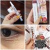 Kem Trị Mụn Thịt Tsubuporon Eye Essence Nhật Bản