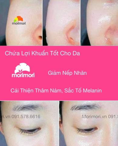 MẶT NẠ  PRO-BIOTICS MASK HÀN QUỐC CHỨA LỢI KHUẨN GIẢM THÂM NÁM, MỜ NẾP NHĂN