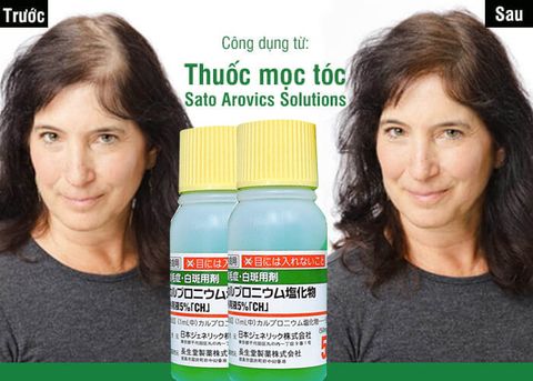 TINH CHẤT THẢO DƯỢC MỌC TÓC AROVICS SOLUTION SATO 5% LỌ 30ML