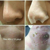 Ủ MỤN ĐẦU ĐEN REMOVE BLACKHEADS