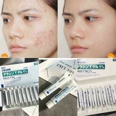 Kem trị mụn 1% da-la-cin-T gel sato 10g Nhật bản