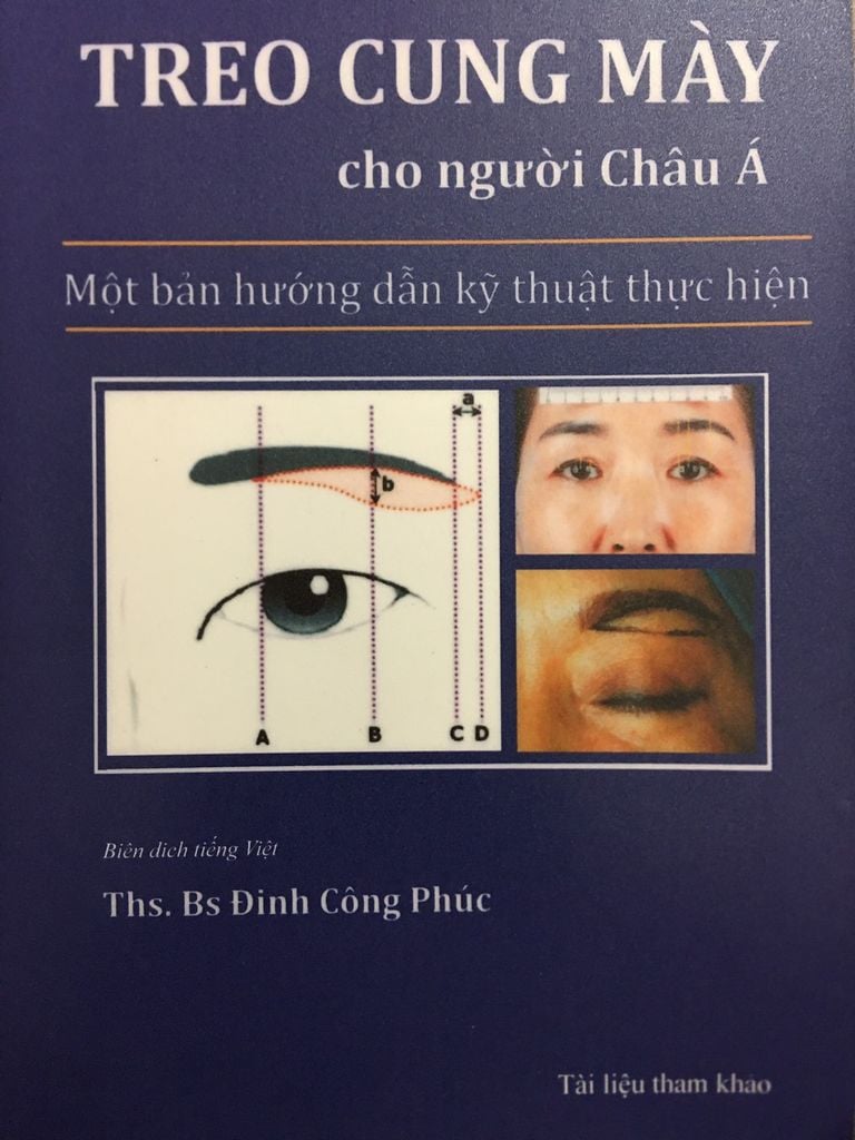 Treo Cung Mày cho người châu á