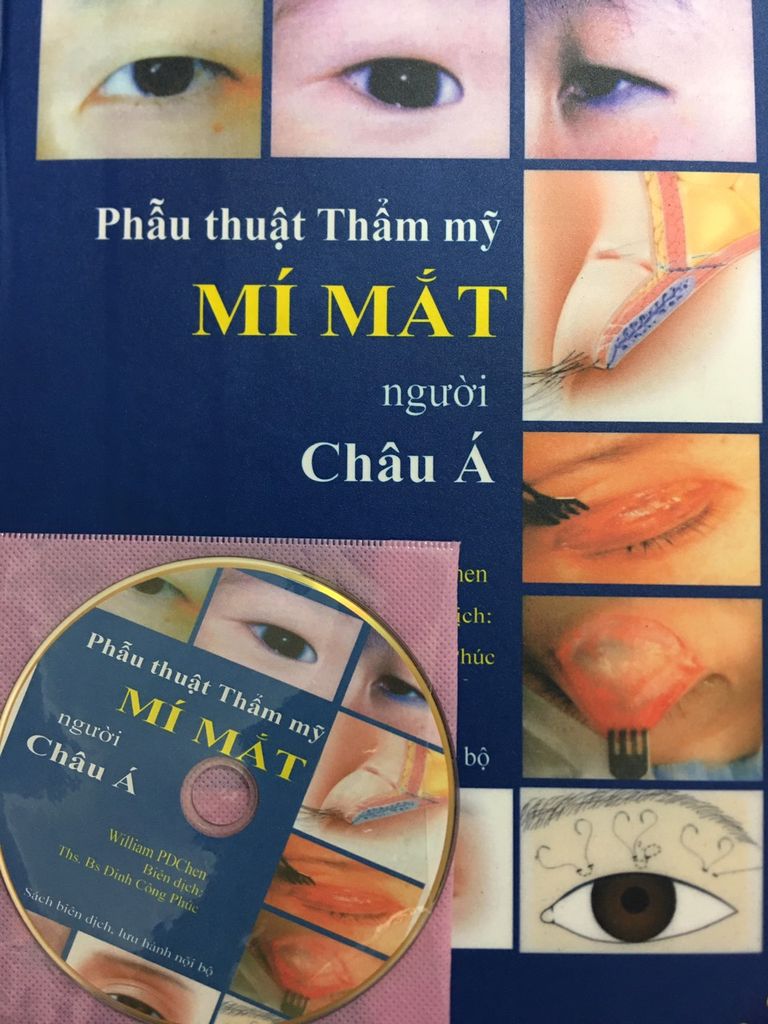 Phẫu thuật thẩm mỹ Mí Mắt của người Châu Á