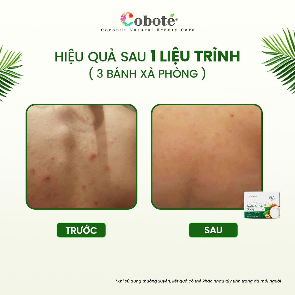 XÀ PHÒNG NGỪA MỤN CƠ THỂ - Coco Miracle Anti Acne Soap 100g