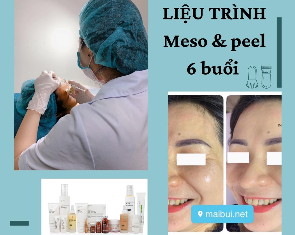  Liệu trình MESO & PEEL (3 buổi) 