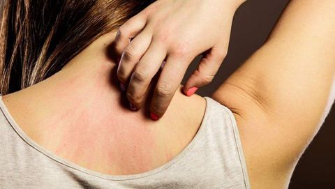 Biểu hiện của dị ứng thời tiết là gì? Nguyên nhân, thực phẩm giảm dị ứng