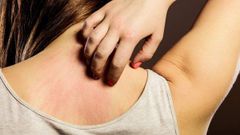  Biểu hiện của dị ứng thời tiết là gì? Nguyên nhân, thực phẩm giảm dị ứng 