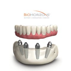 TeethXpress - Hàm giả cố định trên Implant