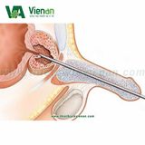 Bộ dụng cụ nong niệu đạo