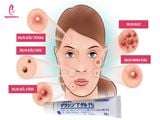cách dùng Kem trị mụn Dalacin T Gel 1% Sato Nhật Bản