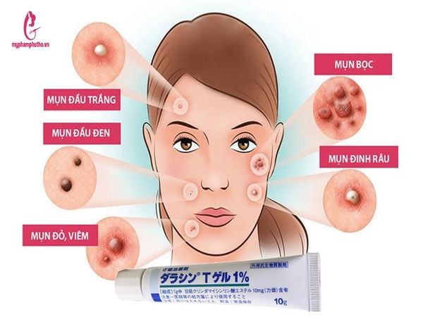 cách dùng Kem trị mụn Dalacin T Gel 1% Sato Nhật Bản