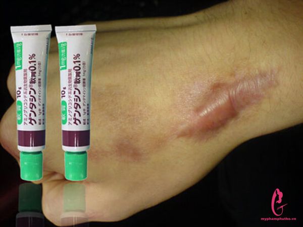 Cách dùng Kem trị sẹo GENTACIN Nhật Bản Lồi Lõm