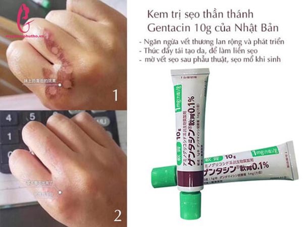 công dụng Kem trị sẹo GENTACIN Nhật Bản Lồi Lõm