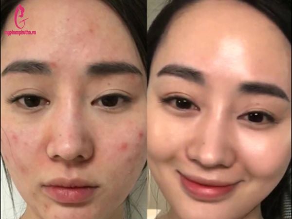 công dụng Kem Dưỡng Trị Mụn AHA-BHA-PHA 30 Days Miracle Cream Some By Mi