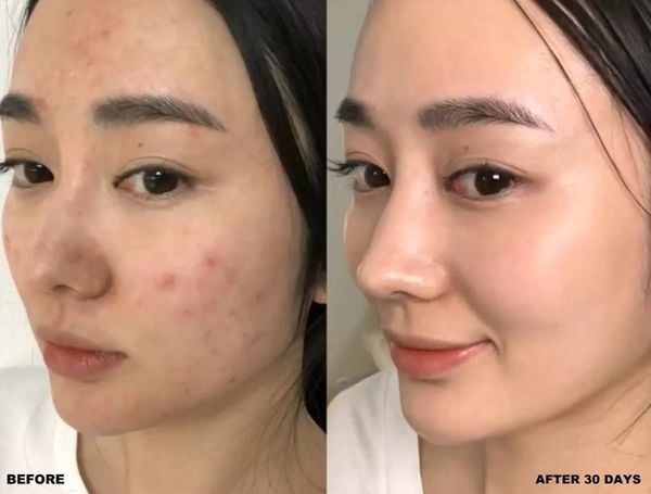 Hướng Dẫn Sử Dụng Tinh chất rau má Skin1004 Hiệu Quả Nhất